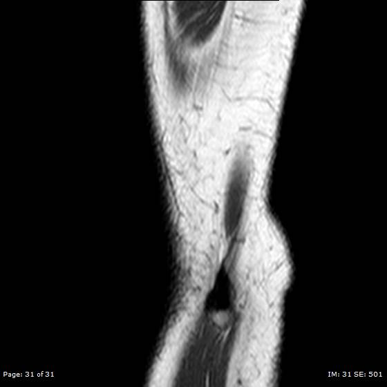 File:Anterior cruciate ligament tear (Radiopaedia 70783-80964 Sagittal T1 31).jpg