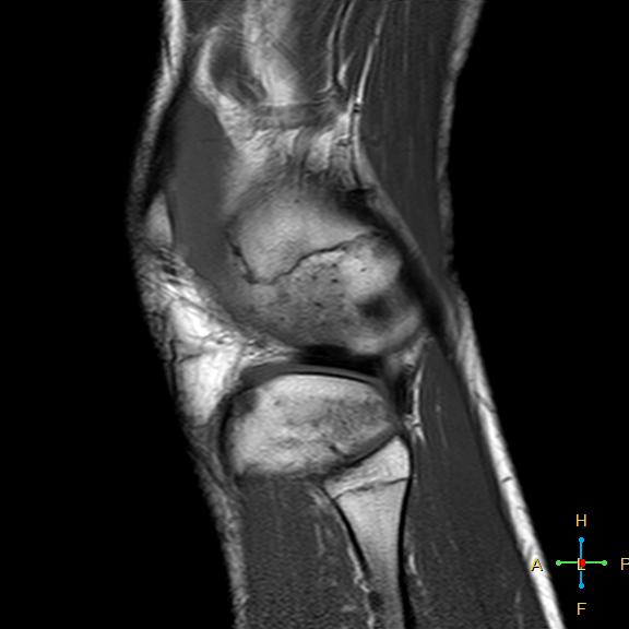 File:Anterior cruciate ligament tear - complete (Radiopaedia 24907-25170 Sagittal T1 2).jpg