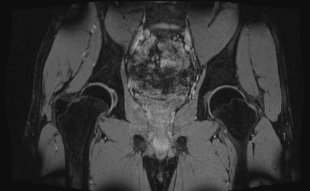 Anterior inferior iliac spine avulsion fracture (Radiopaedia 81312-95000 G 35).jpg