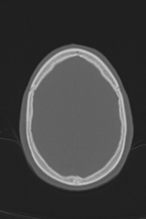Anterior nasal spine fracture (Radiopaedia 46138-50494 Axial bone window 16).png