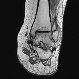 File:Anterior talofibular ligament injury - rupture with soft-tissue impingement (Radiopaedia 38765-40928 Coronal PD 17).jpg