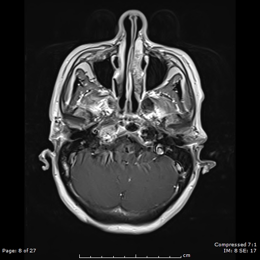 File:Anterior temporal lobe perivascular space (Radiopaedia 88283-104914 Axial T1 C+ 8).jpg