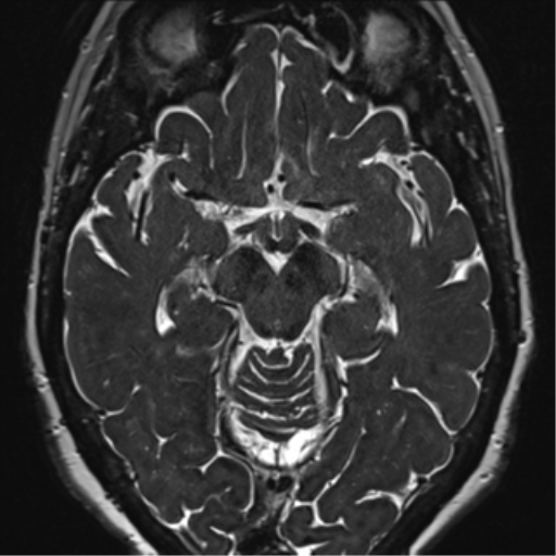 Anterior temporal pole cysts (Radiopaedia 46629-51102 Axial 55).png