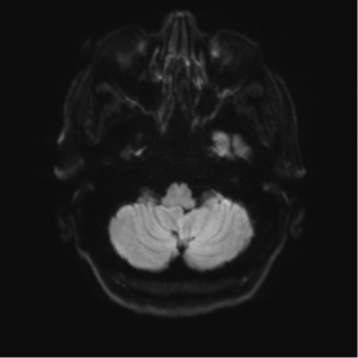 Anterior temporal pole cysts (Radiopaedia 46629-51102 Axial DWI 32).png