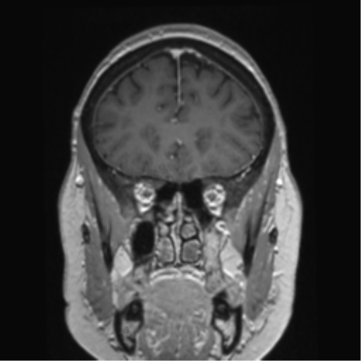 Anterior temporal pole cysts (Radiopaedia 46629-51102 Coronal T1 C+ 127).png