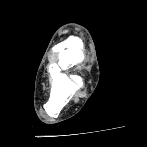 Anterior tibial artery false aneurysm (Radiopaedia 88984-105809 A 159).jpg