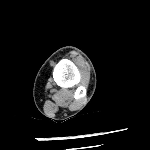 File:Anterior tibial artery false aneurysm (Radiopaedia 88984-105809 A 67).jpg