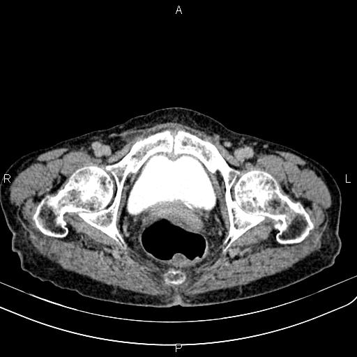 File:Aortic aneurysm and Lemmel syndrome (Radiopaedia 86499-102554 Axial C+ delayed 76).jpg