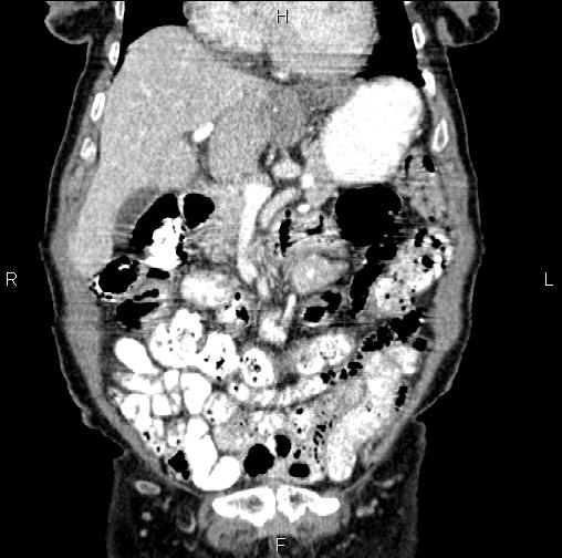 File:Aortic aneurysm and Lemmel syndrome (Radiopaedia 86499-102554 C 17).jpg