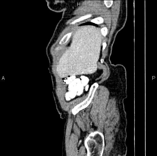 Aortic aneurysm and Lemmel syndrome (Radiopaedia 86499-102554 D 6).jpg