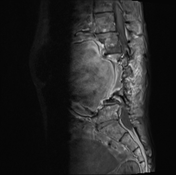 File:Aortic aneurysm with spinal destruction (Radiopaedia 42301-45409 Sagittal T1 fat sat 24).jpg