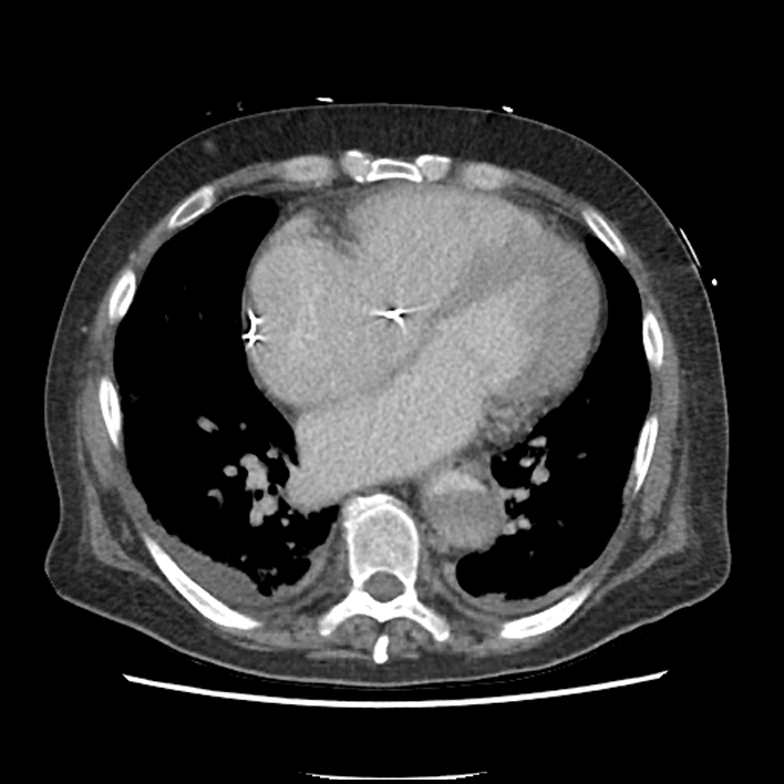 Aortic arch graft infection (FDG PET-CT) (Radiopaedia 71975-82437 A 39).jpg