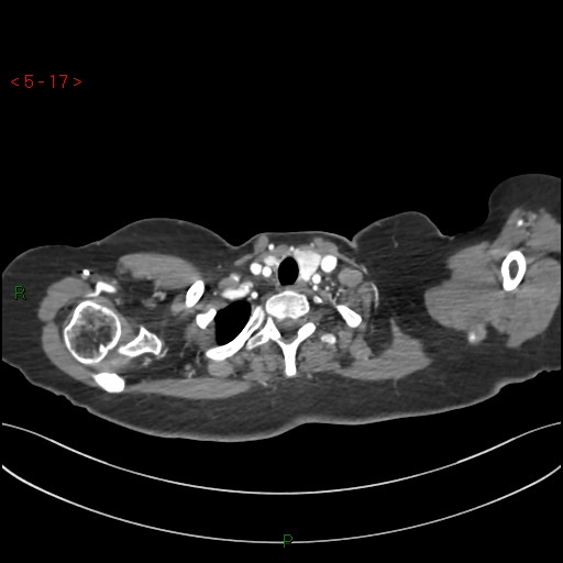 Aortic arch origin of left vertebral artery (Radiopaedia 51520-57286 A 16).jpg