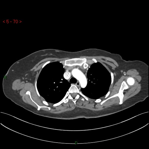 Aortic arch origin of left vertebral artery (Radiopaedia 51520-57286 A 69).jpg