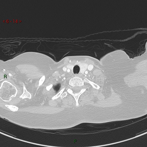 Aortic arch origin of left vertebral artery (Radiopaedia 51520-57286 Axial lung window 14).jpg