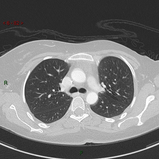 Aortic arch origin of left vertebral artery (Radiopaedia 51520-57286 Axial lung window 82).jpg