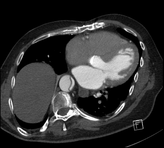 Aortic dissection (CTPA) (Radiopaedia 75506-86750 A 61).jpg