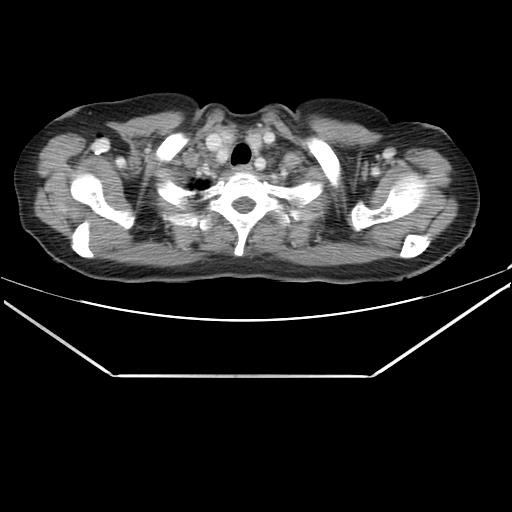 Aortic dissection (Radiopaedia 25350-25604 C 1).jpg