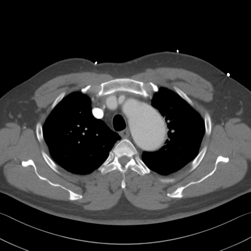 File:Aortic dissection (Radiopaedia 50763-56234 A 9).png
