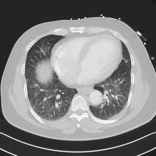 File:Aortic dissection (Radiopaedia 50763-56234 Axial lung window 44).png