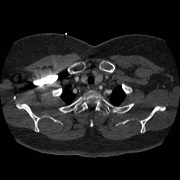 Aortic dissection (Radiopaedia 57969-64959 A 42).jpg