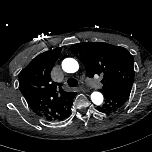 File:Aortic dissection - DeBakey type II (Radiopaedia 64302-73082 A 31).png