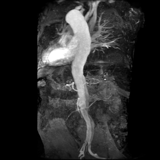 File:Aortic dissection - Stanford A - DeBakey I (Radiopaedia 23469-23551 MRA 15).jpg