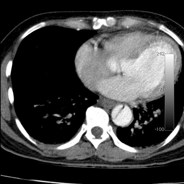 Aortic dissection - Stanford type A (Radiopaedia 29247-29659 A 53).jpg