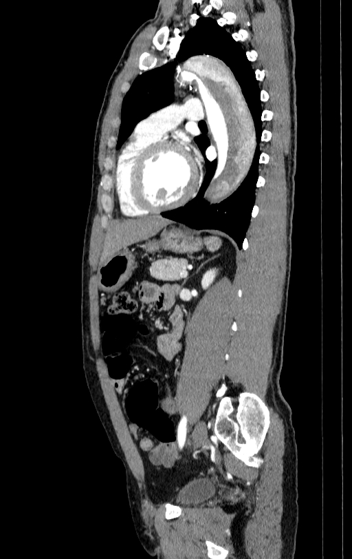 Aortic dissection - Stanford type A (Radiopaedia 83418-98500 B 57).jpg