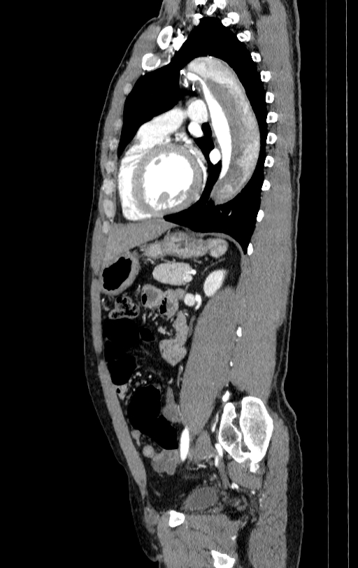 Aortic dissection - Stanford type A (Radiopaedia 83418-98500 B 58).jpg