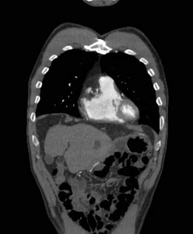 File:Aortic dissection - Stanford type B (Radiopaedia 73648-84437 B 28).jpg