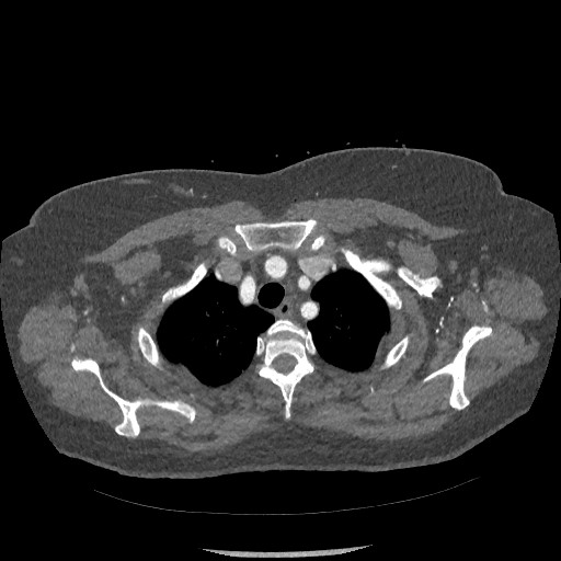 Aortic dissection - Stanford type B (Radiopaedia 88281-104910 A 8).jpg