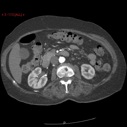 File:Aortic intramural hematoma (Radiopaedia 27746-28001 A 113).jpg