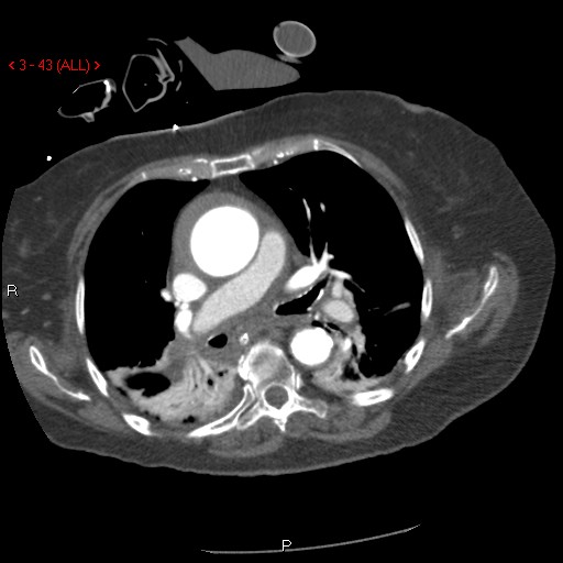 File:Aortic intramural hematoma (Radiopaedia 27746-28001 A 43).jpg