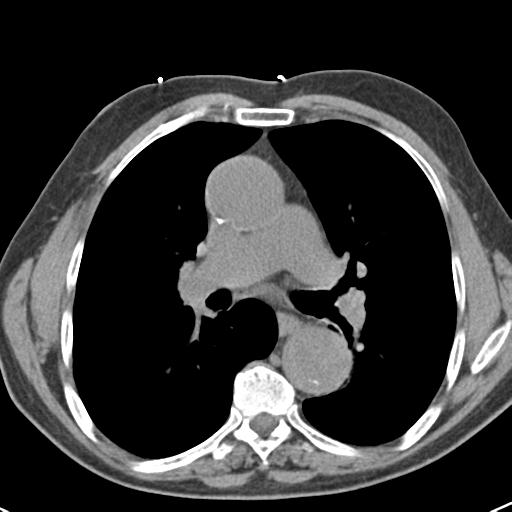 Aortic intramural hematoma (Radiopaedia 31139-31838 Axial non-contrast 26).jpg