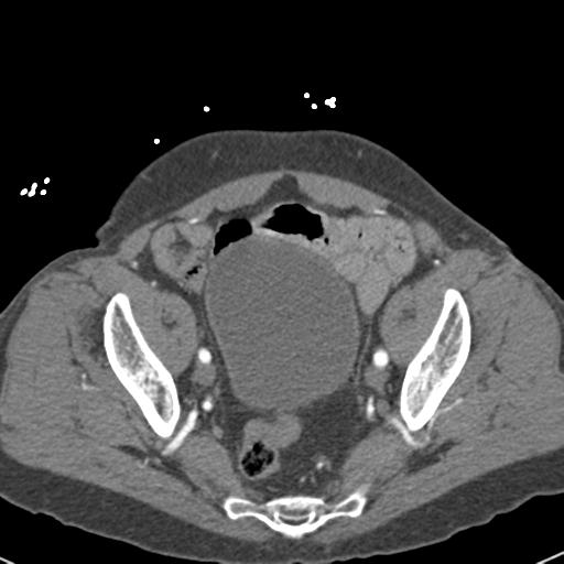 Aortic intramural hematoma (Radiopaedia 31139-31838 B 149).jpg