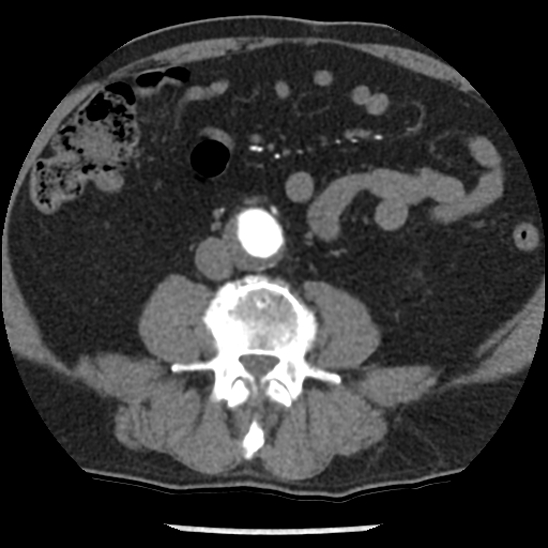 Aortic intramural hematoma (type B) (Radiopaedia 79323-92387 B 80).jpg