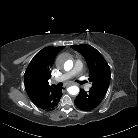 Aortic intramural hematoma with dissection and intramural blood pool (Radiopaedia 77373-89491 B 56).jpg