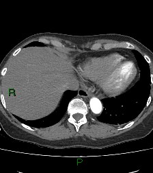 Aortic valve endocarditis (Radiopaedia 87209-103485 C 77).jpg