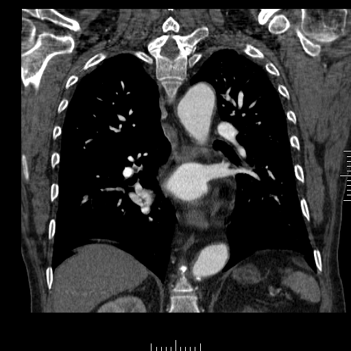 File:Aorto-coronary bypass graft aneurysms (Radiopaedia 40562-43157 B 30).png