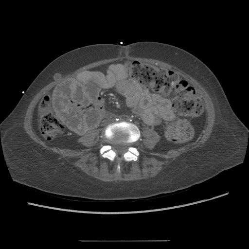 Aorto-duodenal fistula (Radiopaedia 25668-25850 A 49).jpg