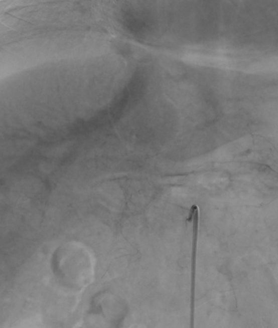 Aorto portal shunt (Radiopaedia 69573-79586 Frontal Celiac axis 74).jpg