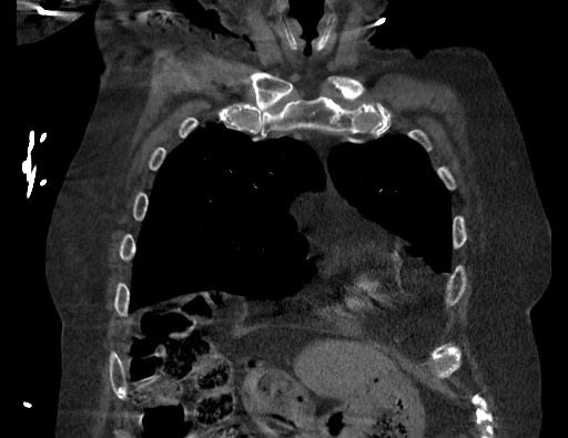 Aortoesophageal fistula with endovascular repair (Radiopaedia 73781-84592 Coronal C+ CTPA 20).jpg