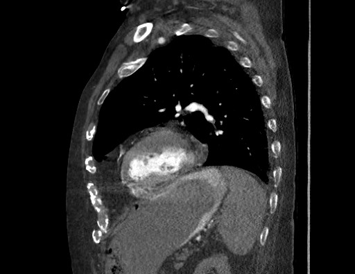 Aortoesophageal fistula with endovascular repair (Radiopaedia 73781-84592 Sagittal C+ CTPA 141).jpg