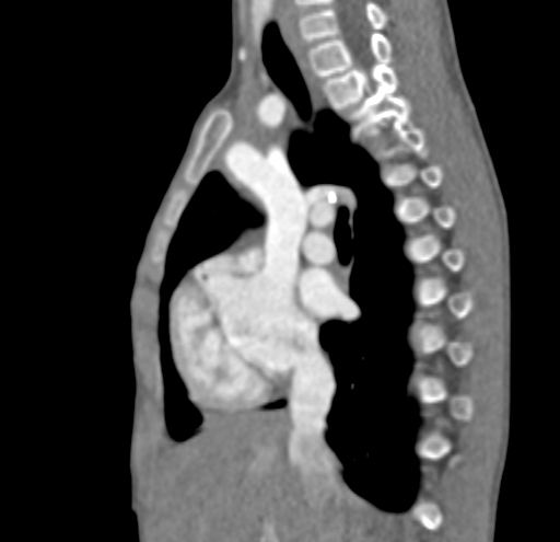 File:Aortopulmonary window, interrupted aortic arch and large PDA giving the descending aorta (Radiopaedia 35573-37074 C 5).jpg