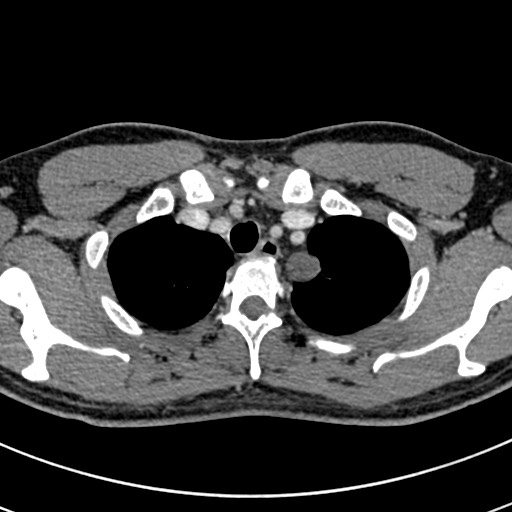 Apical lung mass mimic - neurogenic tumor (Radiopaedia 59918-67521 A 13).jpg