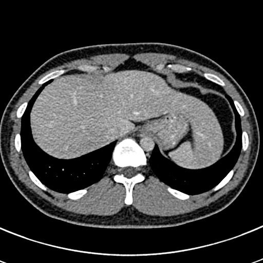 Apical lung mass mimic - neurogenic tumor (Radiopaedia 59918-67521 A 72).jpg