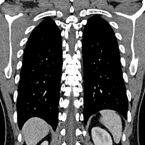 Apical lung mass mimic - neurogenic tumor (Radiopaedia 59918-67521 B 83).jpg