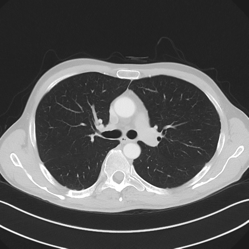 Apical pleural calcification (Radiopaedia 46141-50499 Axial lung window 27).png