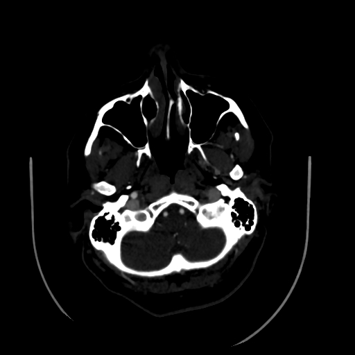 Aplasia of the internal carotid artery (Radiopaedia 61082-68960 A 10).jpg